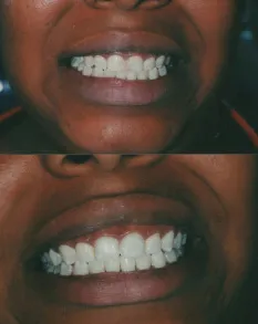 Above & Beyond Dental — Cosmetic dentistry result — Borger, TX