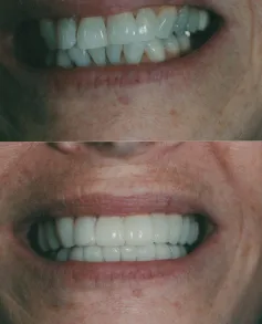 Above & Beyond Dental — Patient smile makeover — Borger, TX