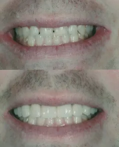 Above & Beyond Dental — Restored smile after treatment — Borger, TX